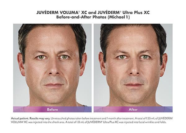 Juvederm Before & After Image