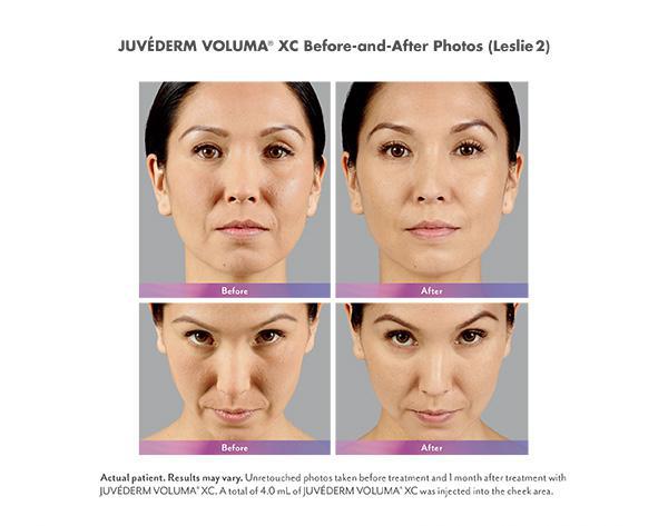 Juvederm Before & After Image