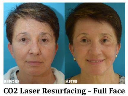 Laser Resurfacing Before & After Image
