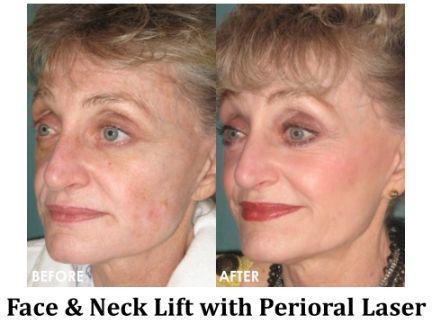 Laser Resurfacing Before & After Image