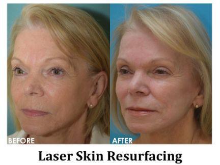 Laser Resurfacing Before & After Image