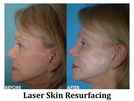 Laser Resurfacing Before & After Image