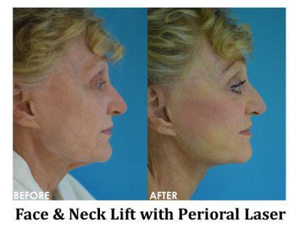 Laser Resurfacing Before & After Image