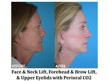 Laser Resurfacing Before & After Image