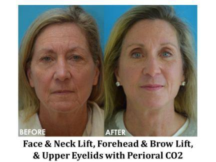 Laser Resurfacing Before & After Image