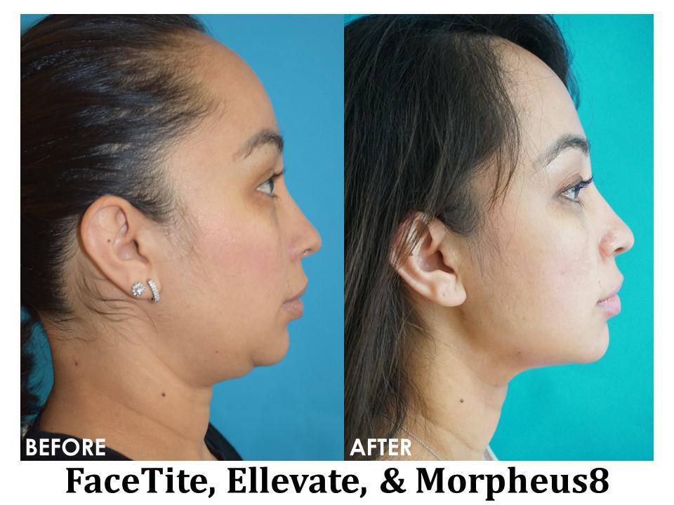 Non Surgical Facelift Before & After Image
